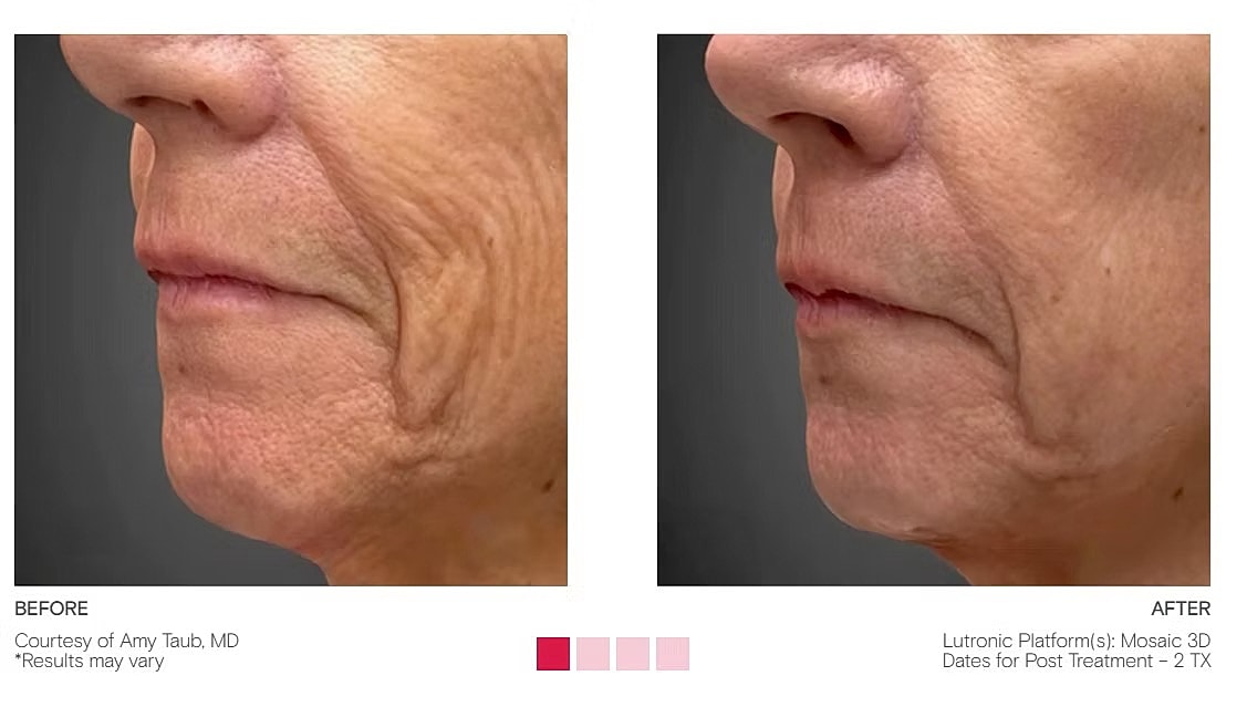 Skin rejuvenation treatment before and after comparison.