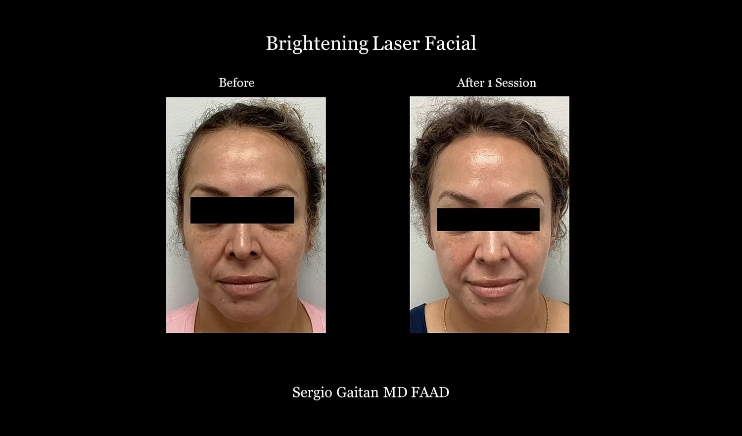 Laser facial before and after results comparison