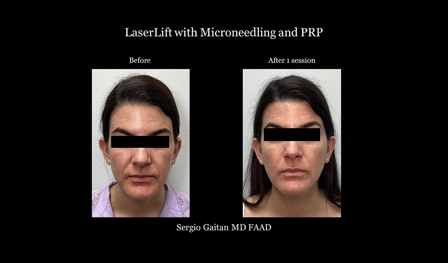 Before and after LaserLift treatment results.
