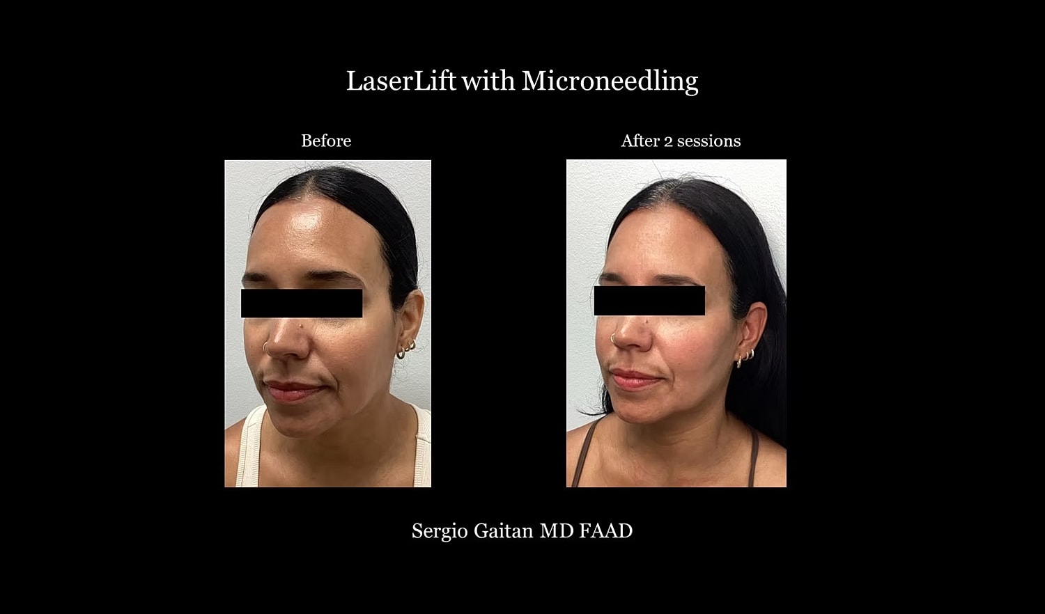 Before and after LaserLift with Microneedling.