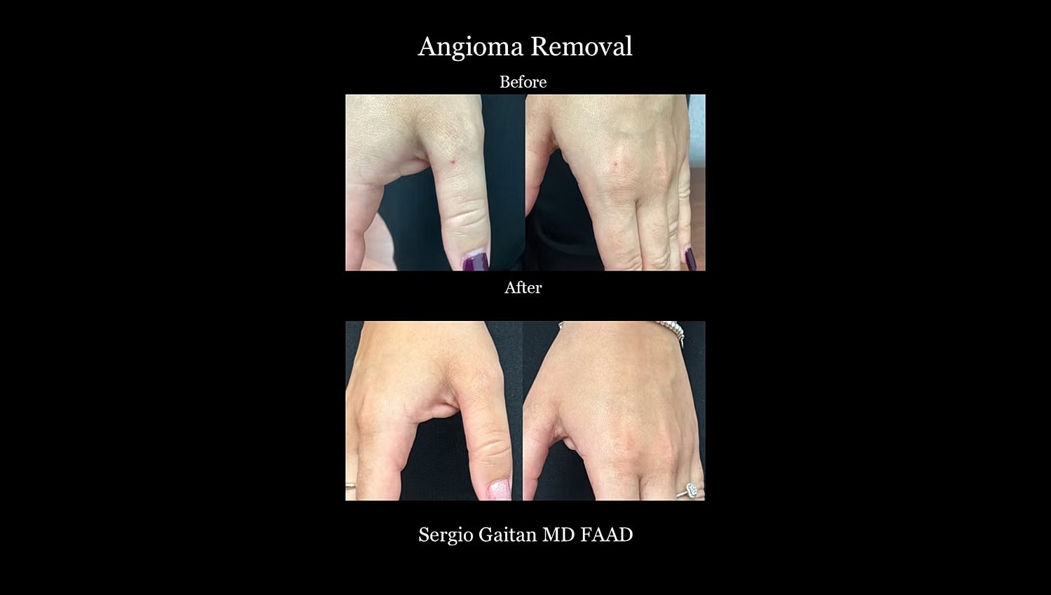 Angioma removal before and after treatment.