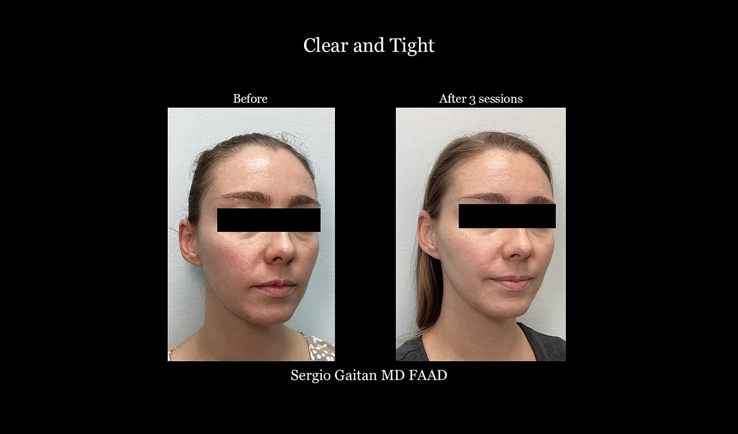 Before and after facial treatment results.