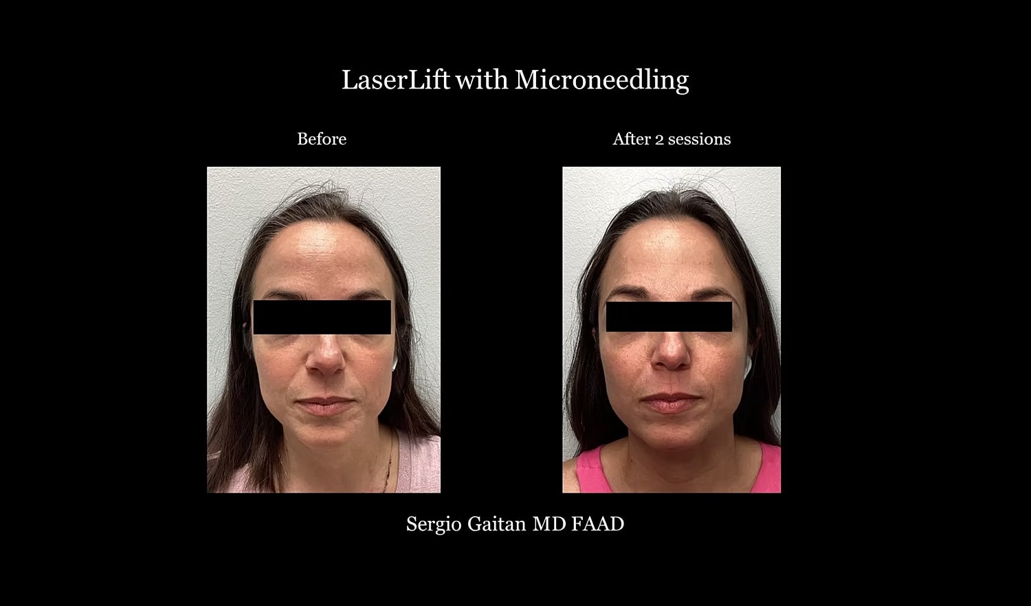 Microneedling results before and after treatment.