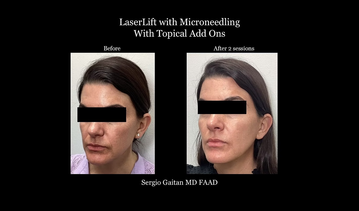 LaserLift before and after microneedling treatment