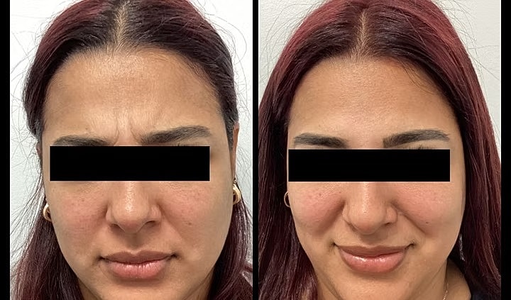 Before and after facial treatment comparison photo.