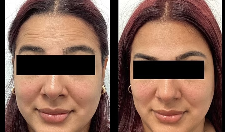 Before and after facial treatment comparison photo.