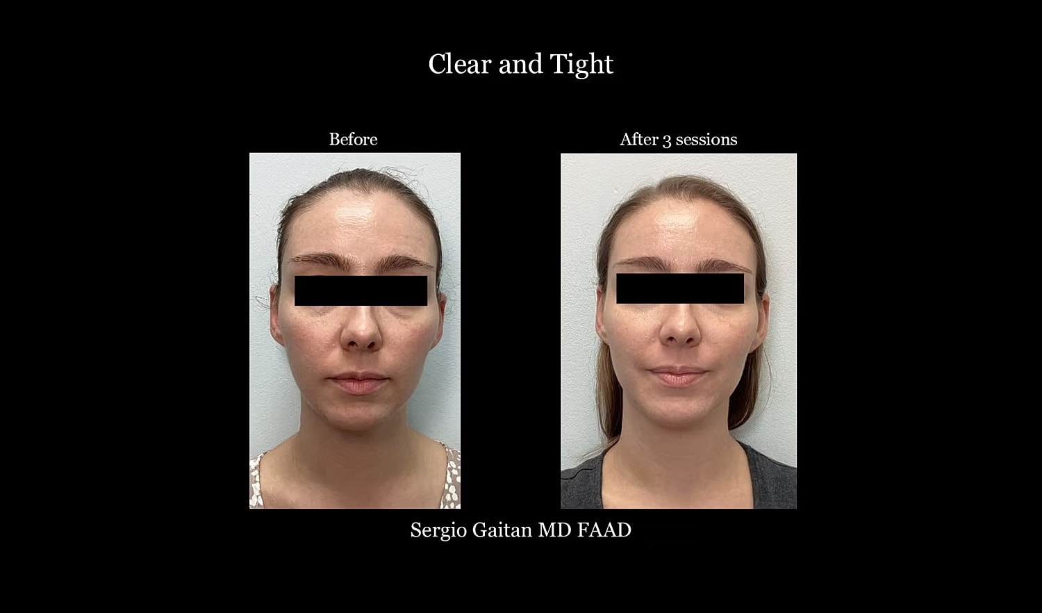 Before and after facial treatment comparison image.