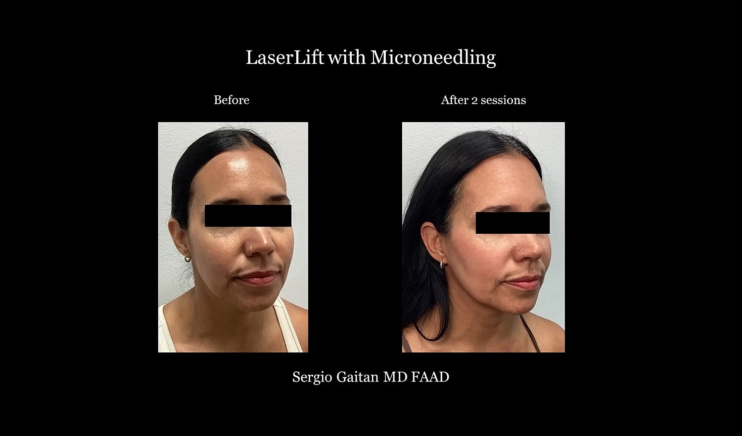 Before and after laser lift with microneedling.