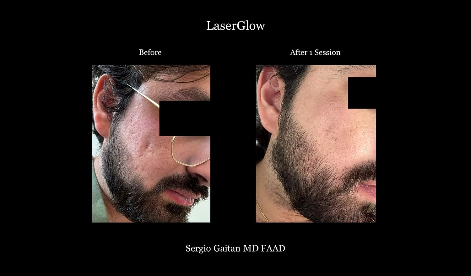Before and after laser treatment comparison image
