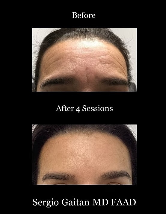 Forehead wrinkles before and after treatment comparison