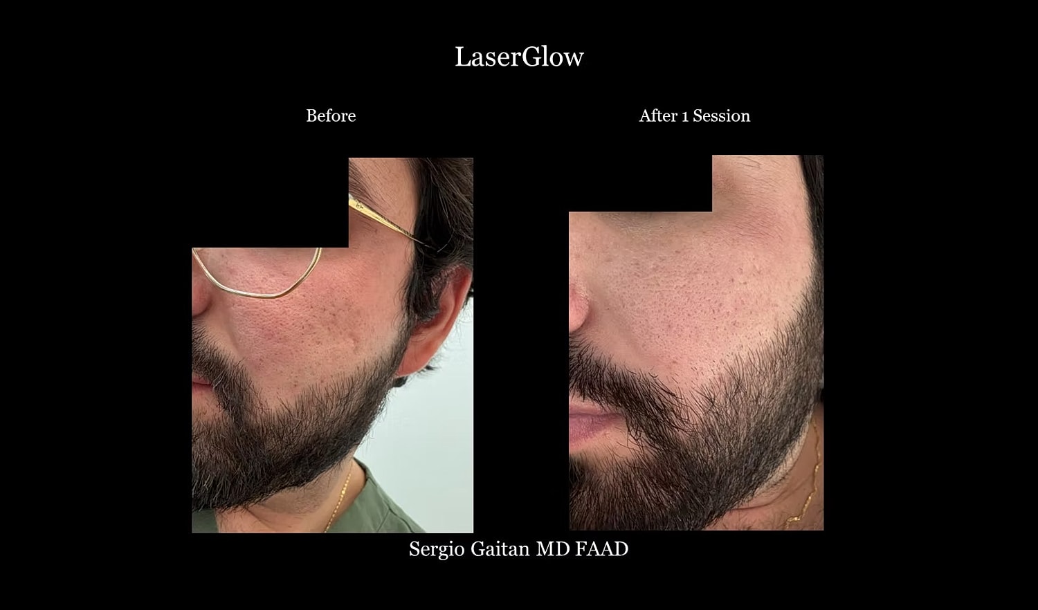 Laser treatment results: before and after comparison.