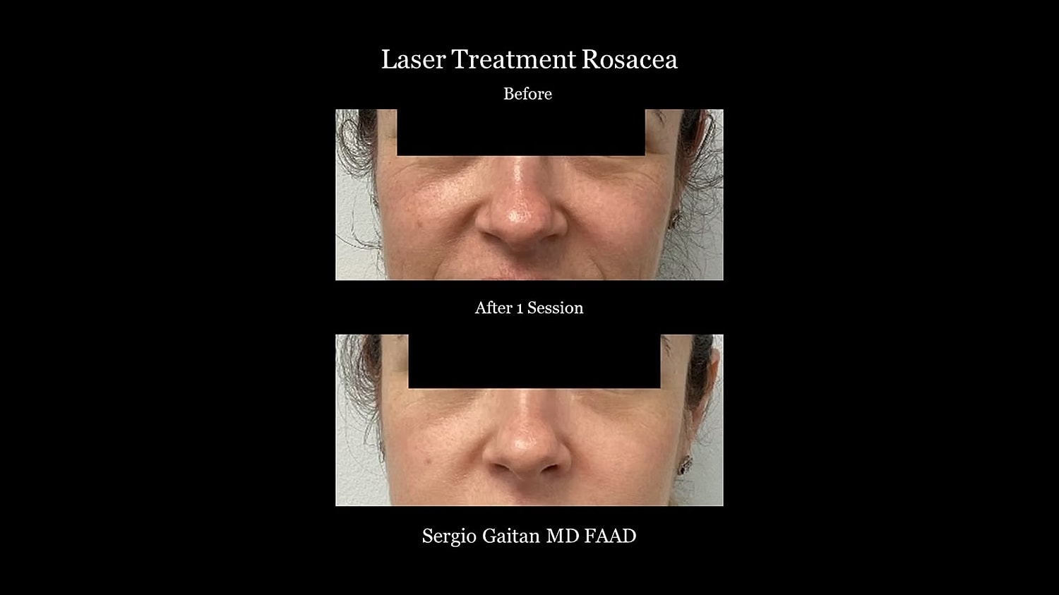 Before and after laser rosacea treatment images.