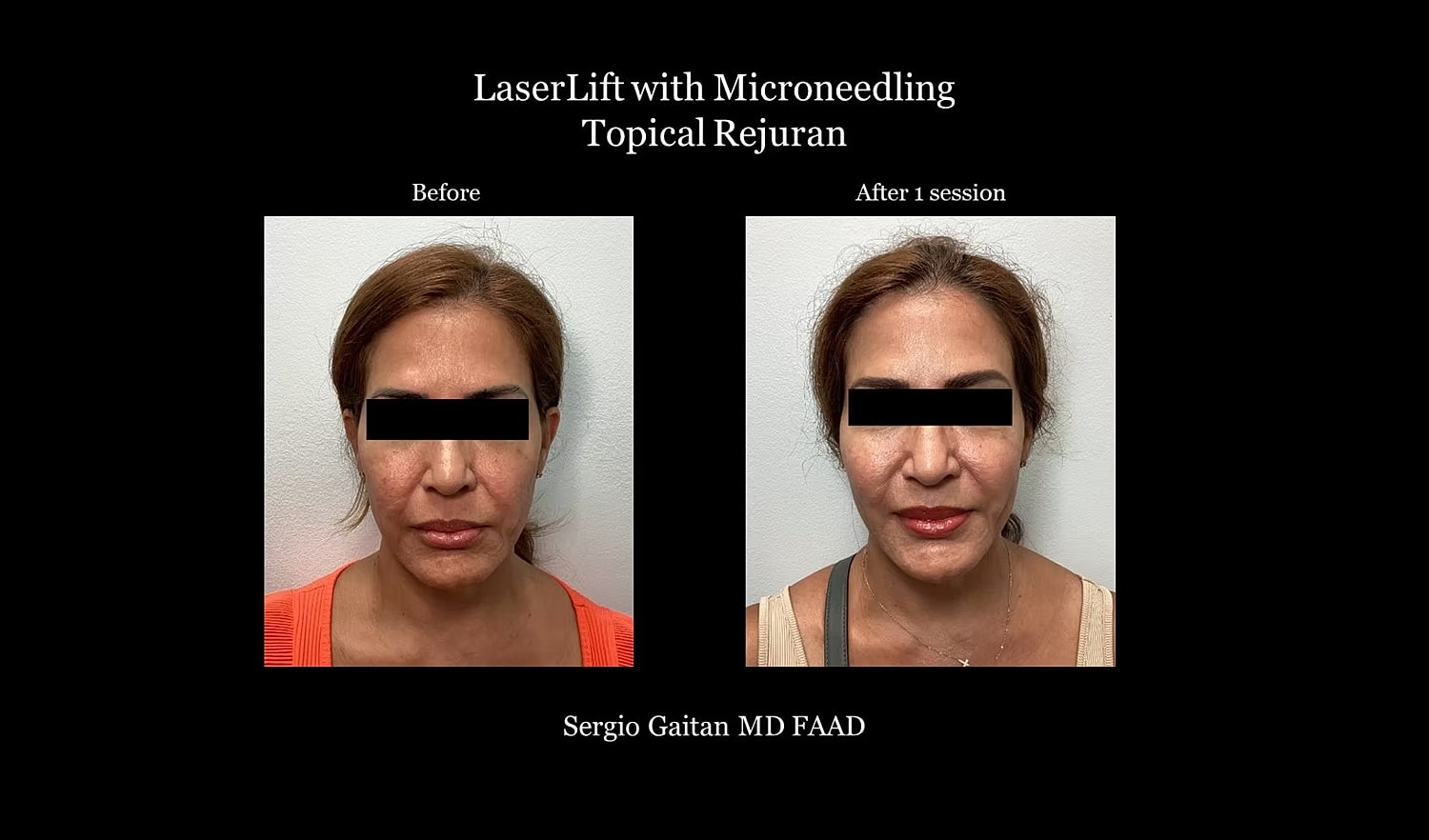 Before and after laser treatment results comparison.