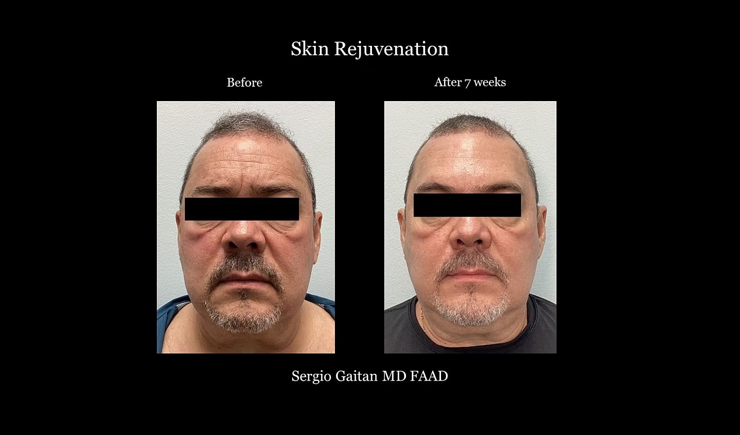 Skin rejuvenation before and after treatment comparison.