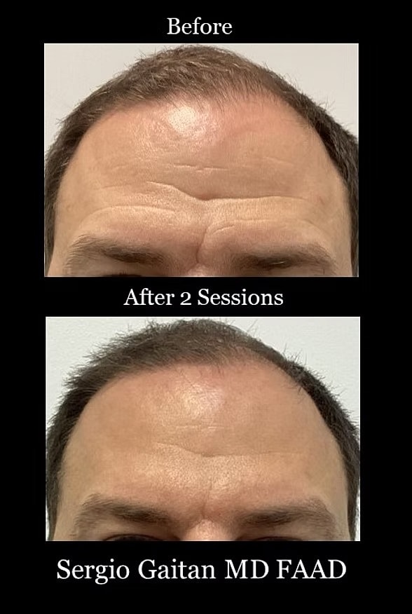 Hair restoration results before and after sessions
