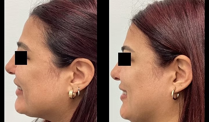 Profile comparison before and after treatment