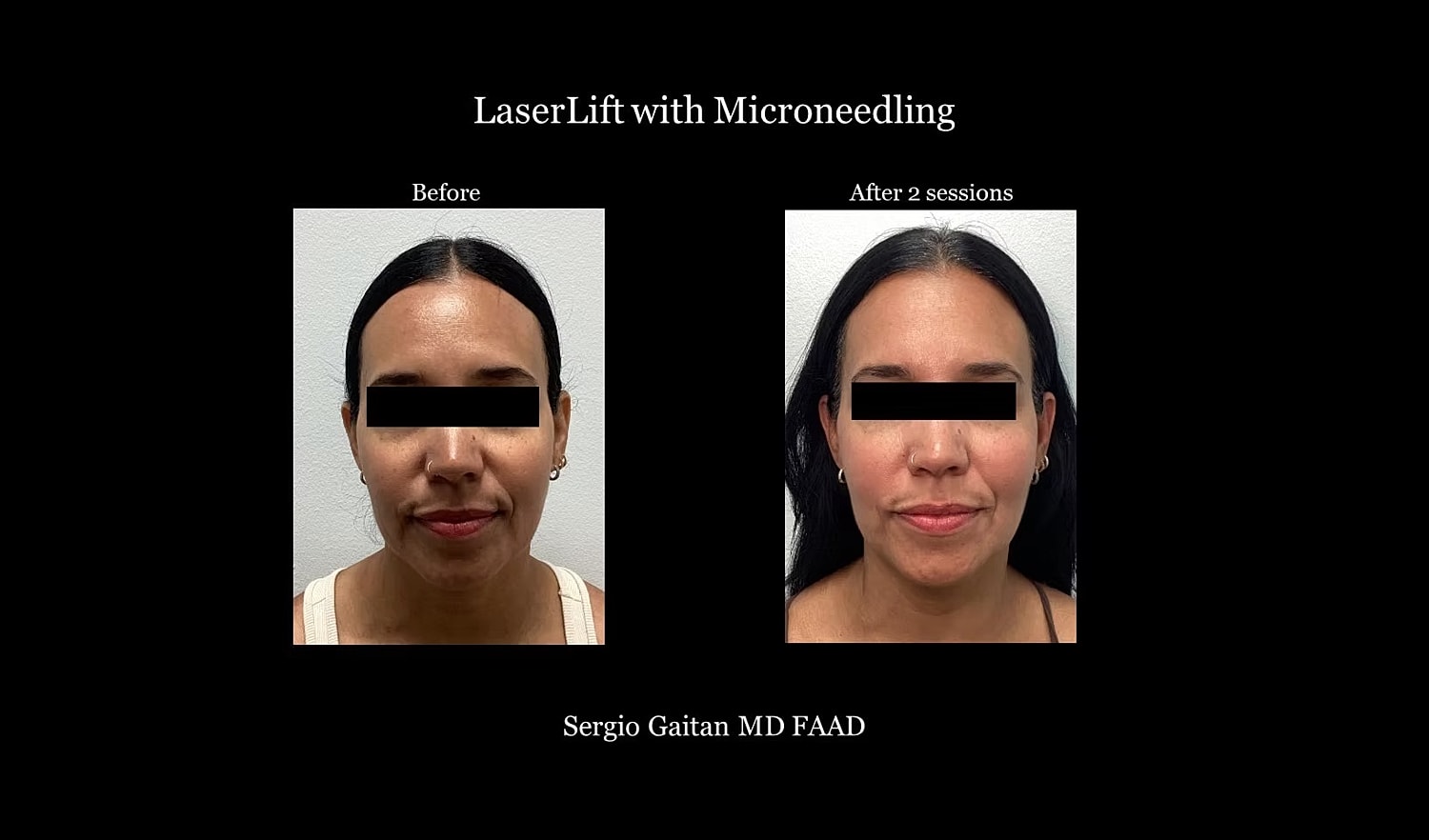 Before and after LaserLift with microneedling.