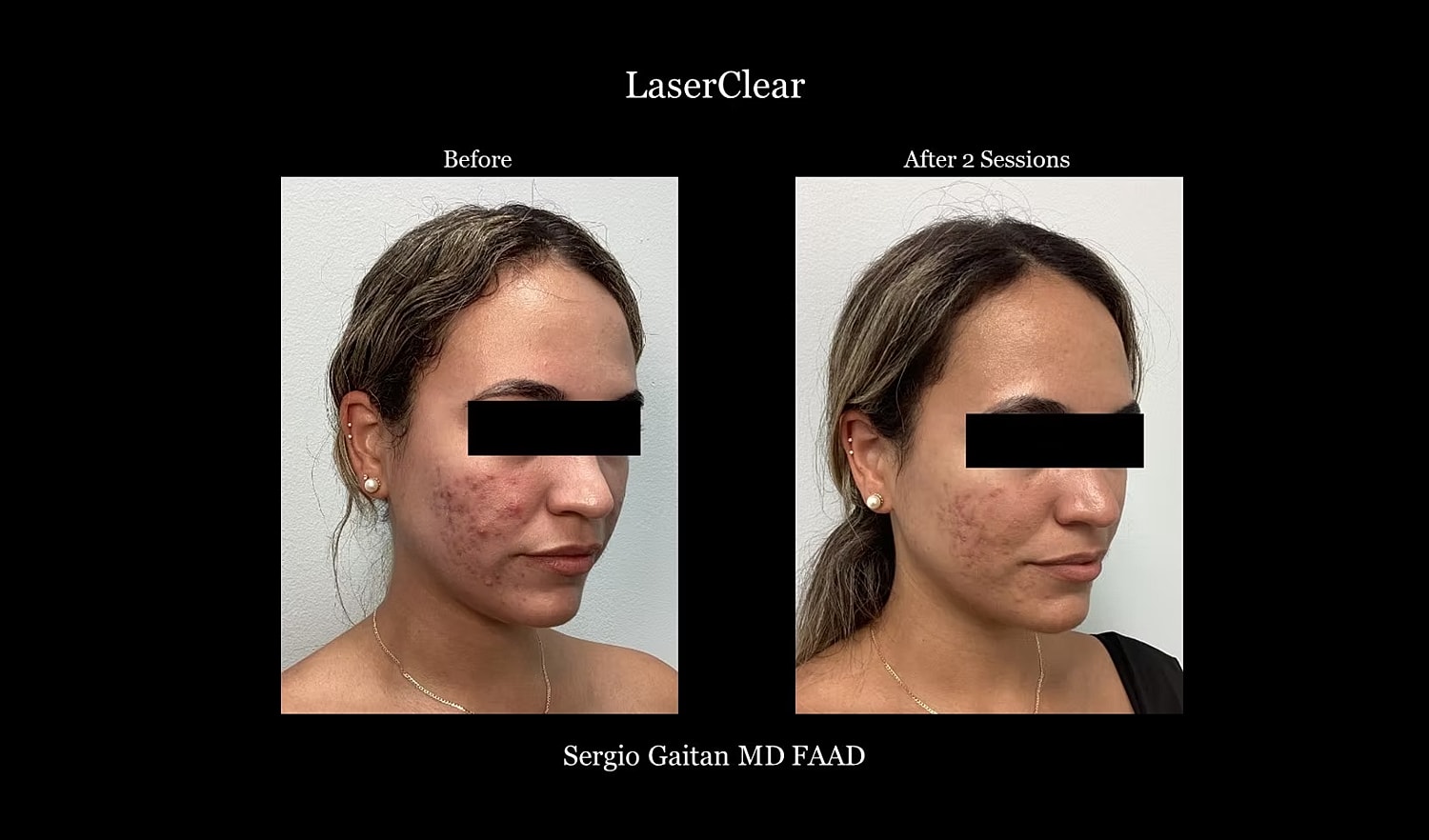 LaserClear treatment before and after comparison.