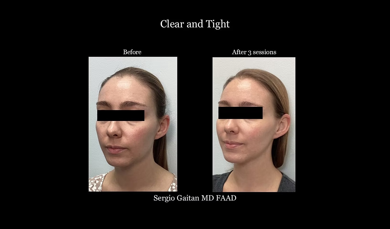 Before and after skincare treatment results.