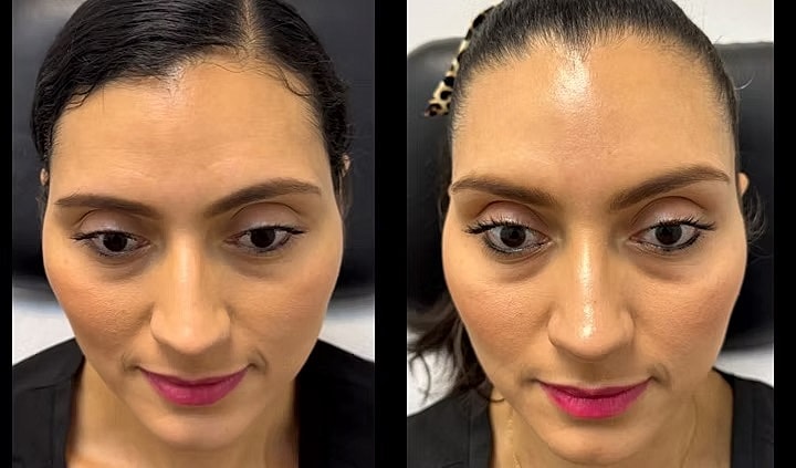 Before and after facial treatment comparison.