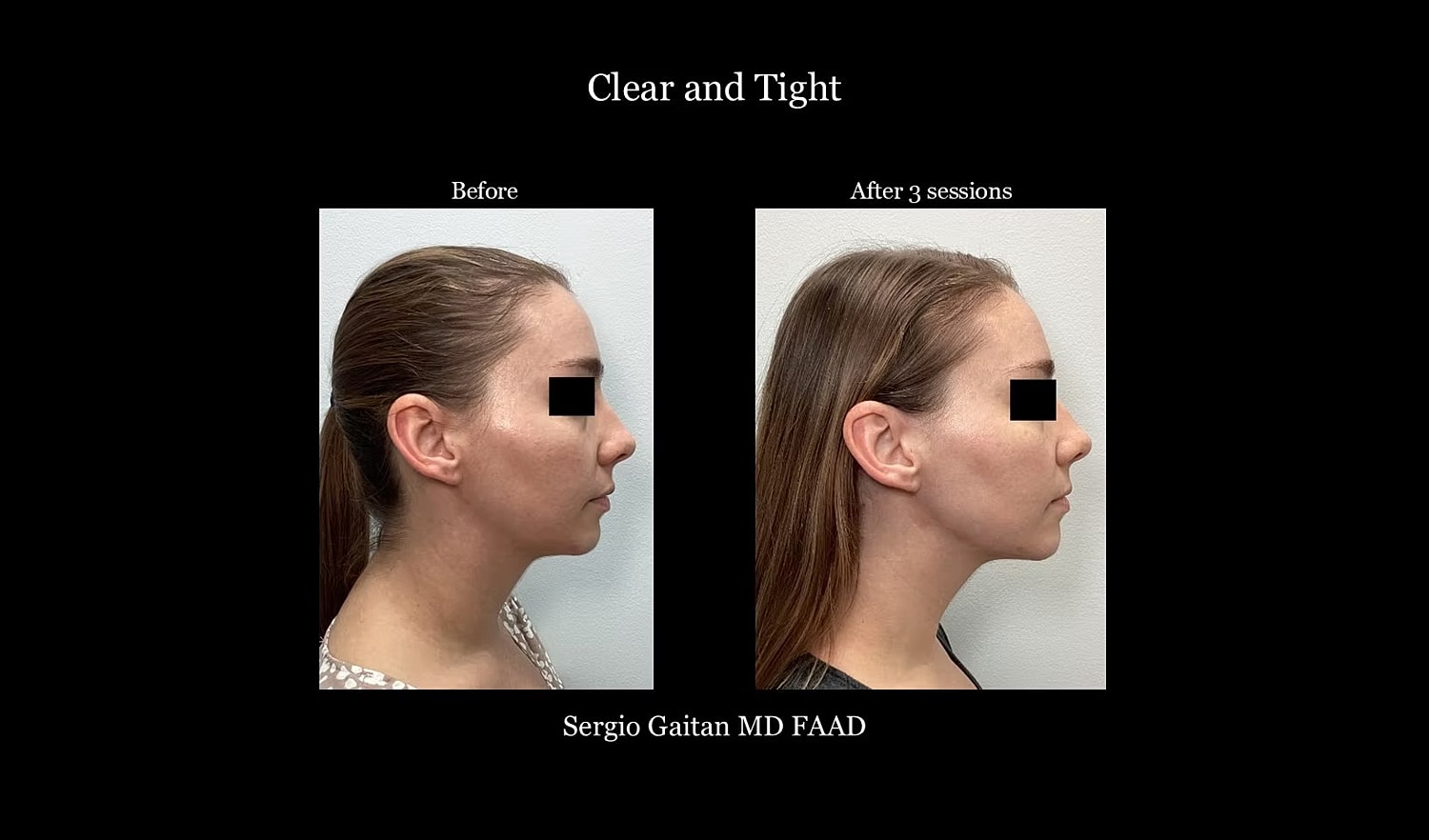 Facial transformation before and after treatment.