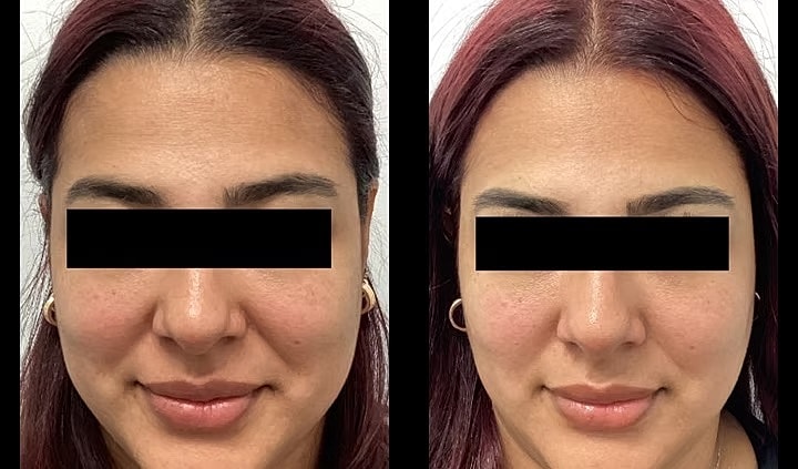 Before and after facial treatment comparison.