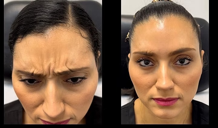Before and after facial treatment comparison.
