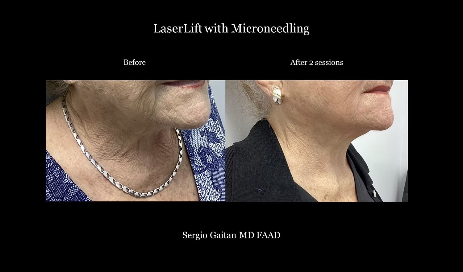 Before and after LaserLift with Microneedling treatment.