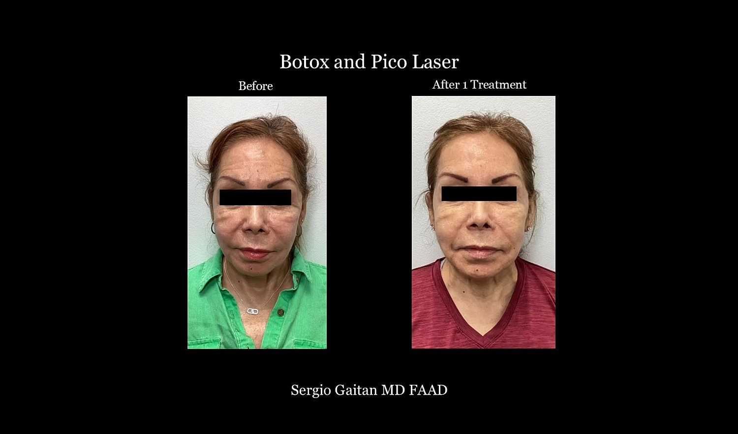 Botox and Pico Laser treatment before and after.
