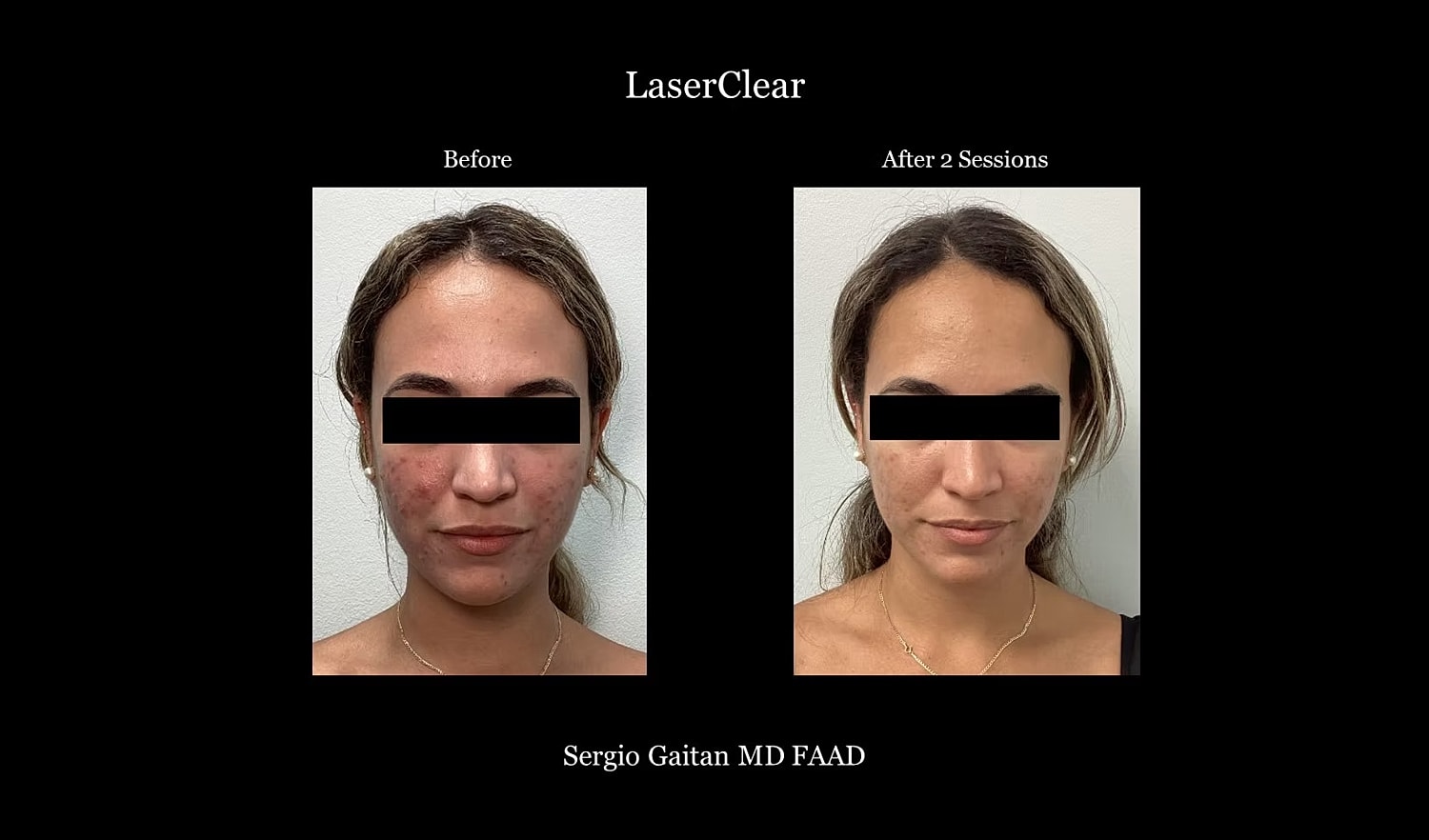 Laser treatment results: before and after images.