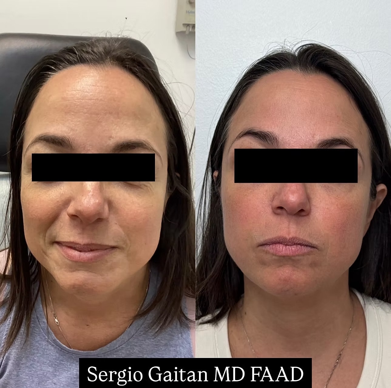 Before and after skin treatment comparison.