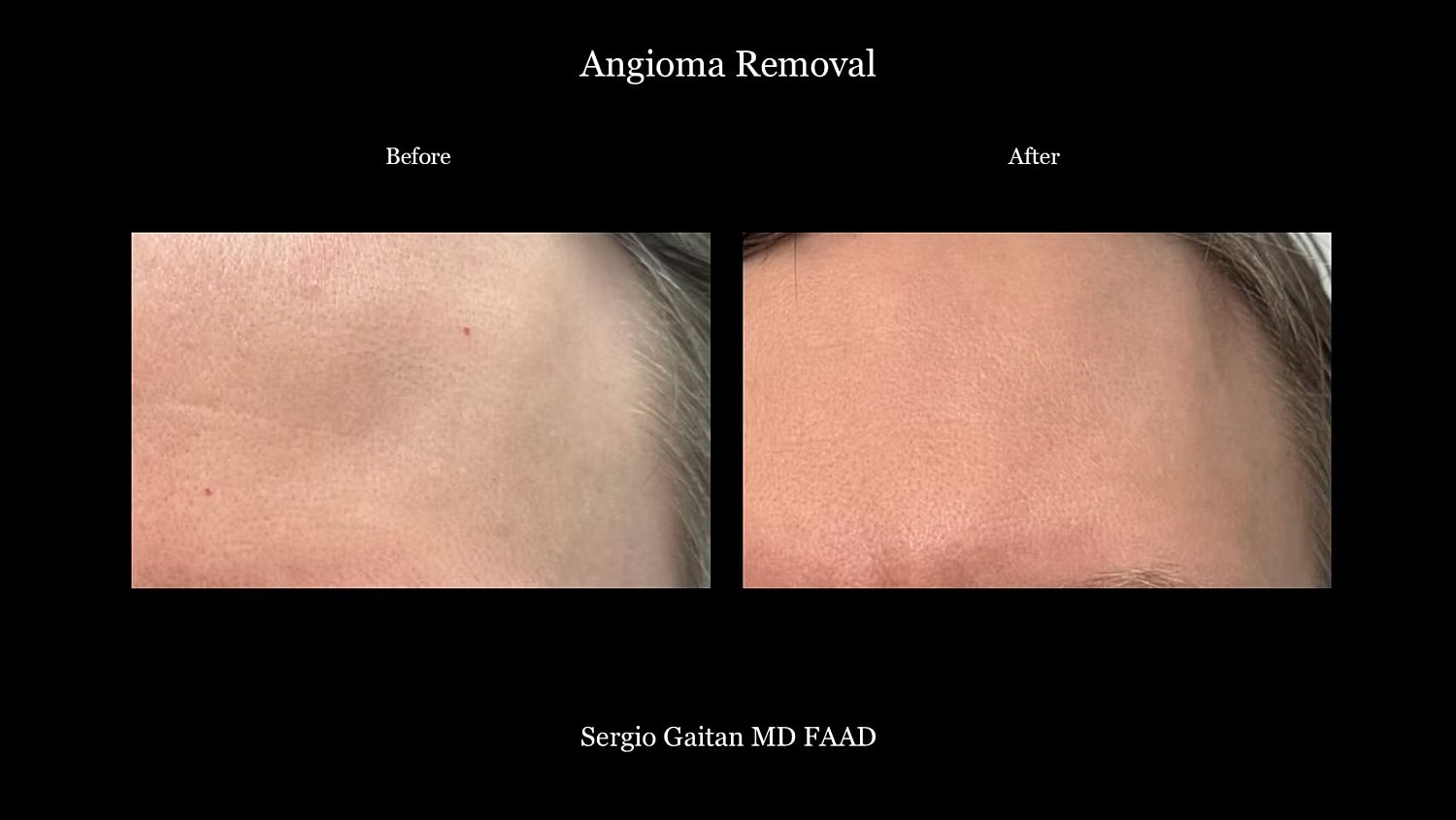 Angioma removal before and after treatment comparison.