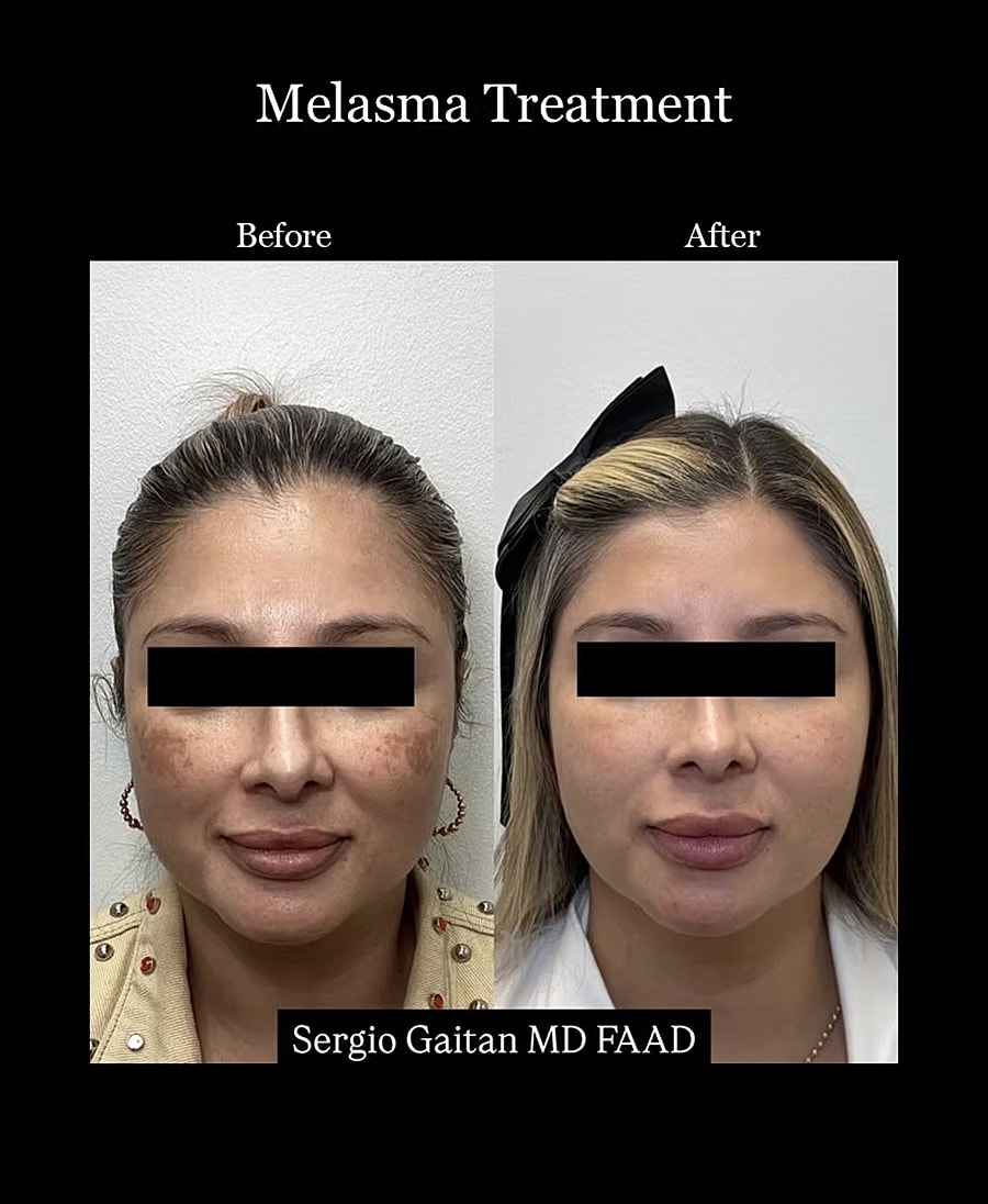 Melasma treatment before and after results.