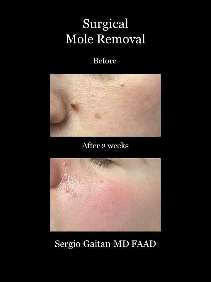 Surgical Dermatology Before & After