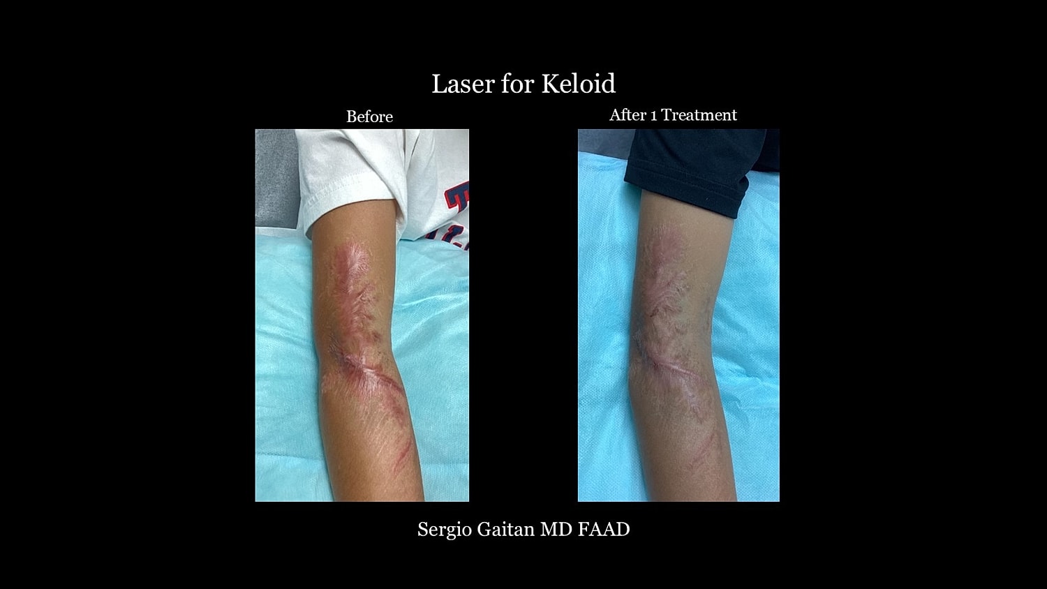 Keloid Before & After