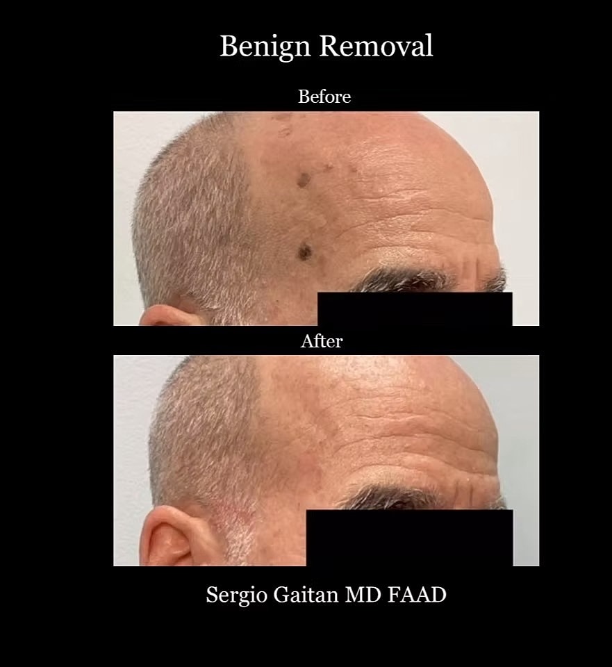 Mole and Dark Spot Removal  Before & After