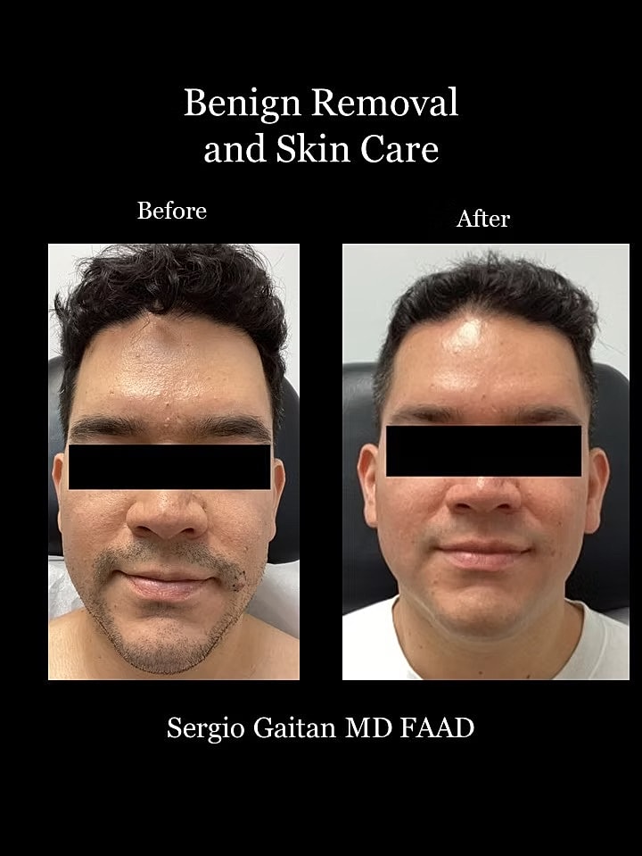 Mole and Dark Spot Removal  Before & After