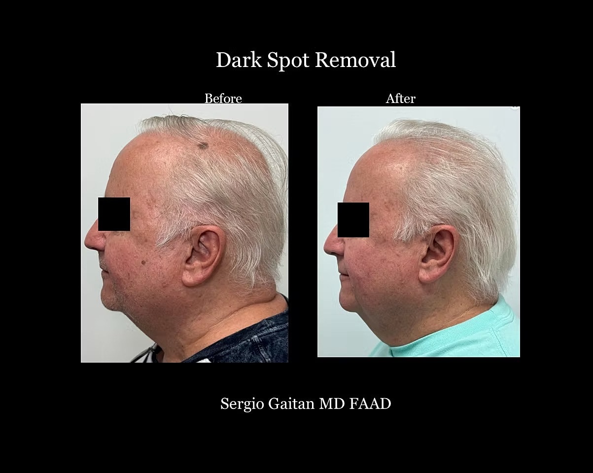 Mole and Dark Spot Removal  Before & After