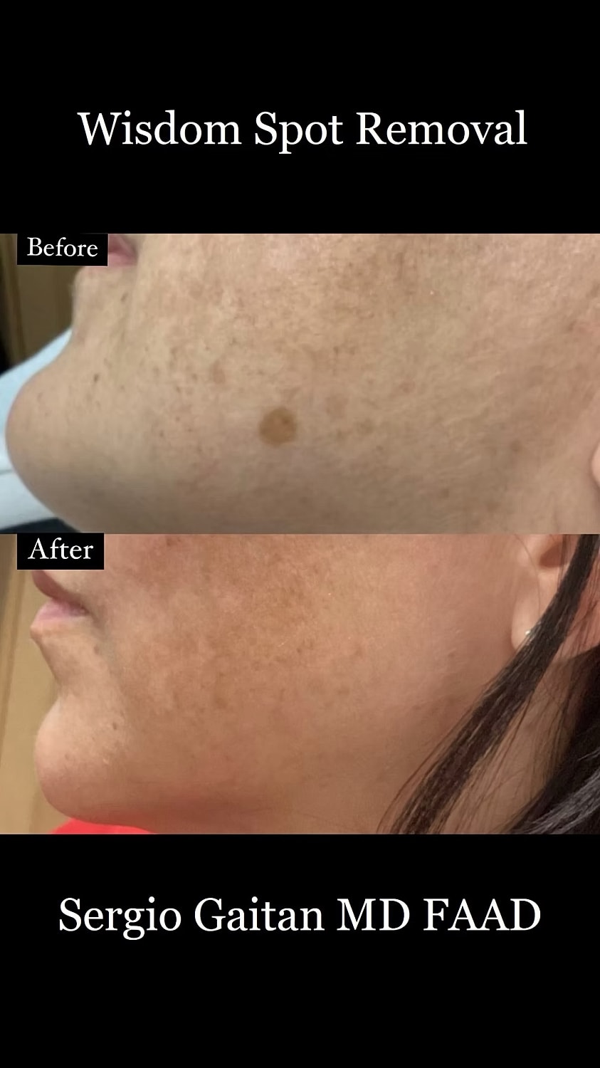 Mole and Dark Spot Removal  Before & After