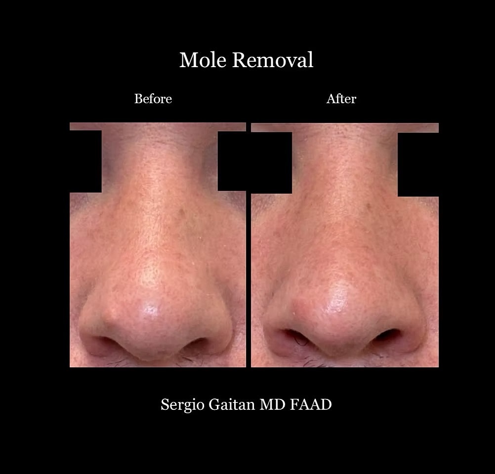 Mole and Dark Spot Removal  Before & After