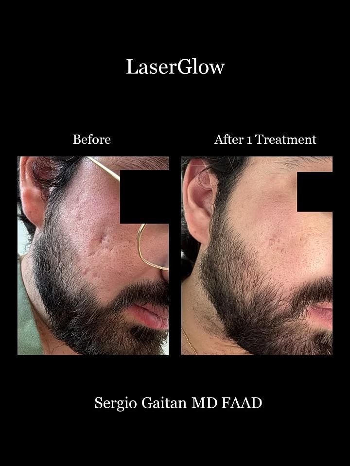 Laserglow Before & After
