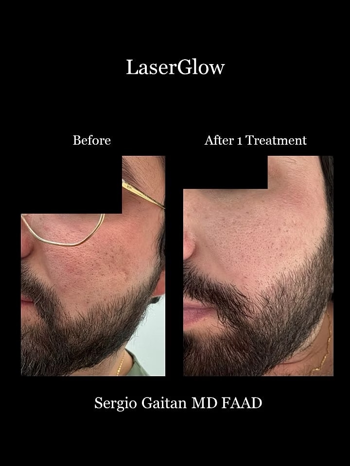 Laserglow Before & After
