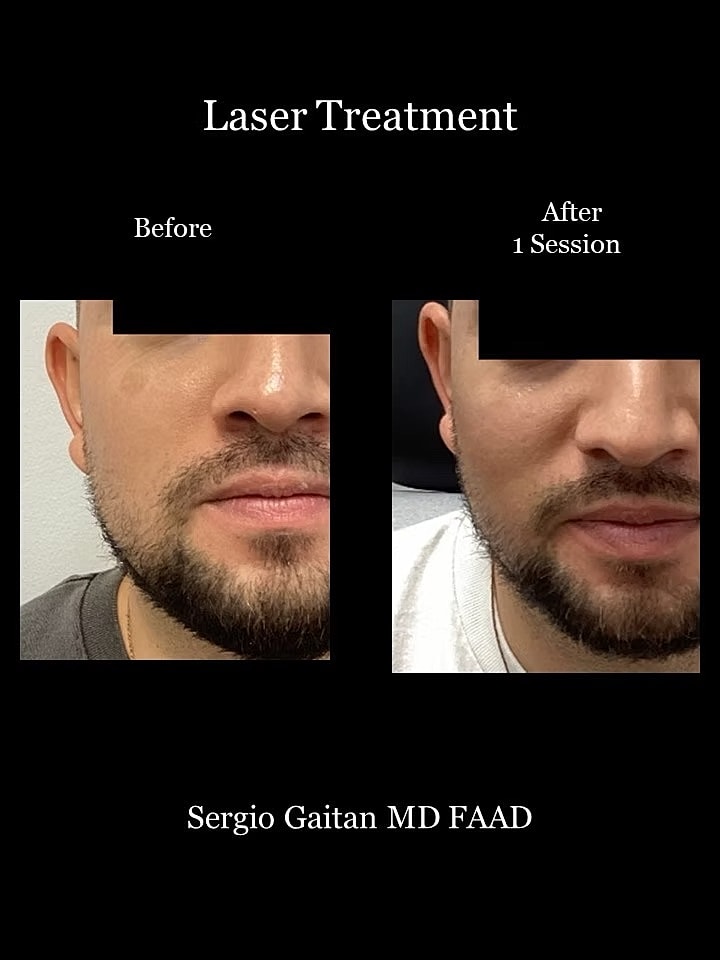 Laser Dark Spot Removal Face Before & After
