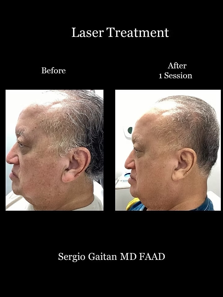 Laser Dark Spot Removal Face Before & After