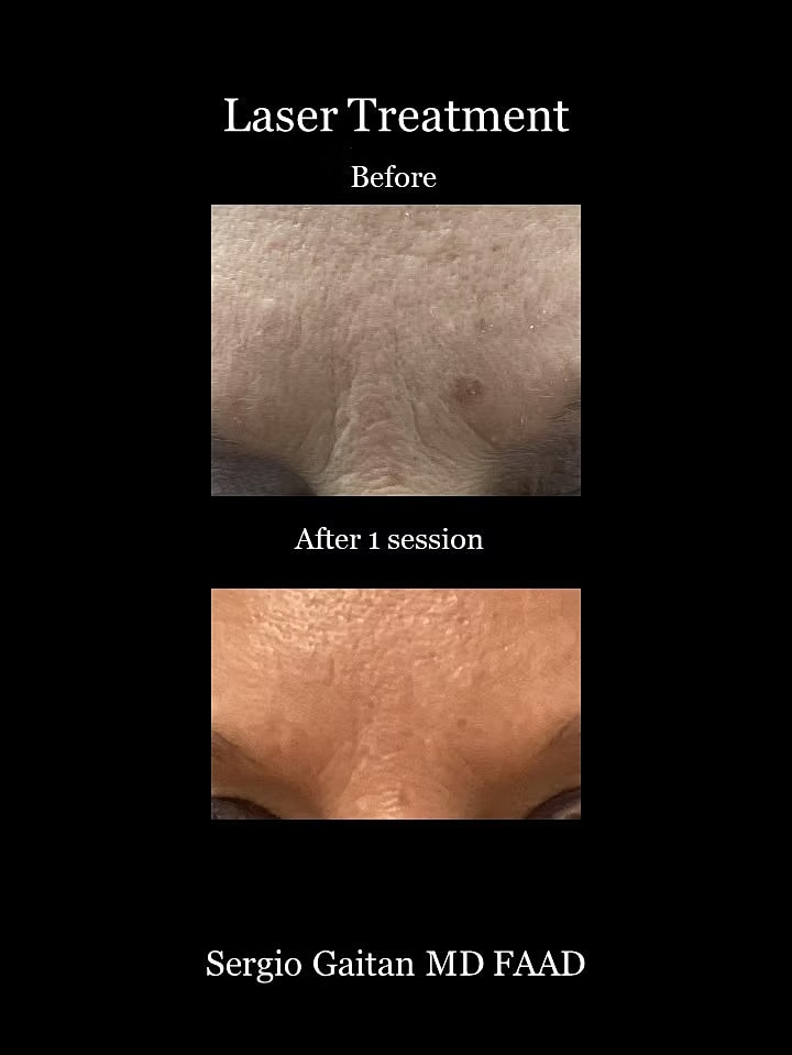 Laser Dark Spot Removal Face Before & After
