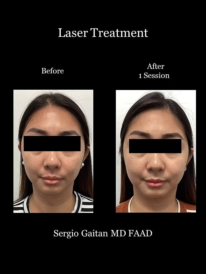 Brightening Laser Facial Before & After