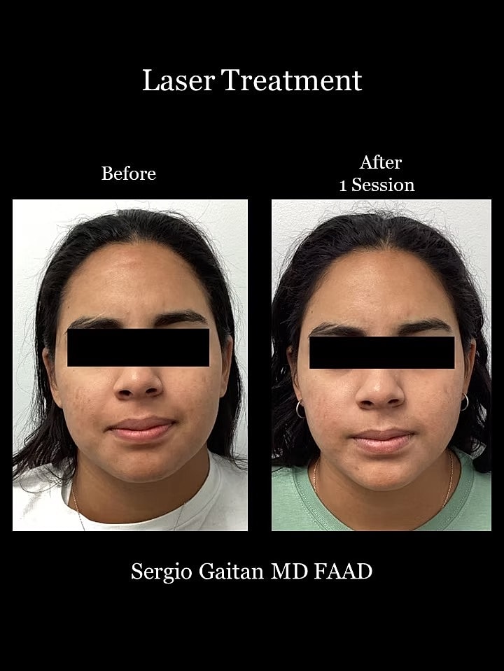Brightening Laser Facial Before & After