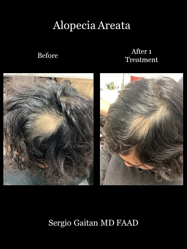Alopecia Areata Before & After