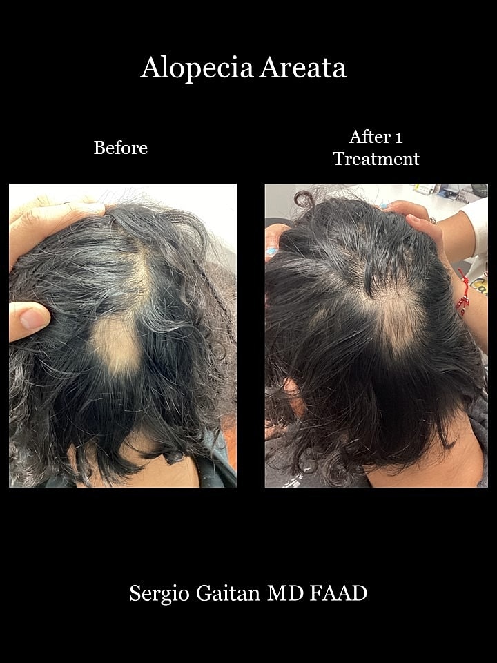Alopecia Areata Before & After