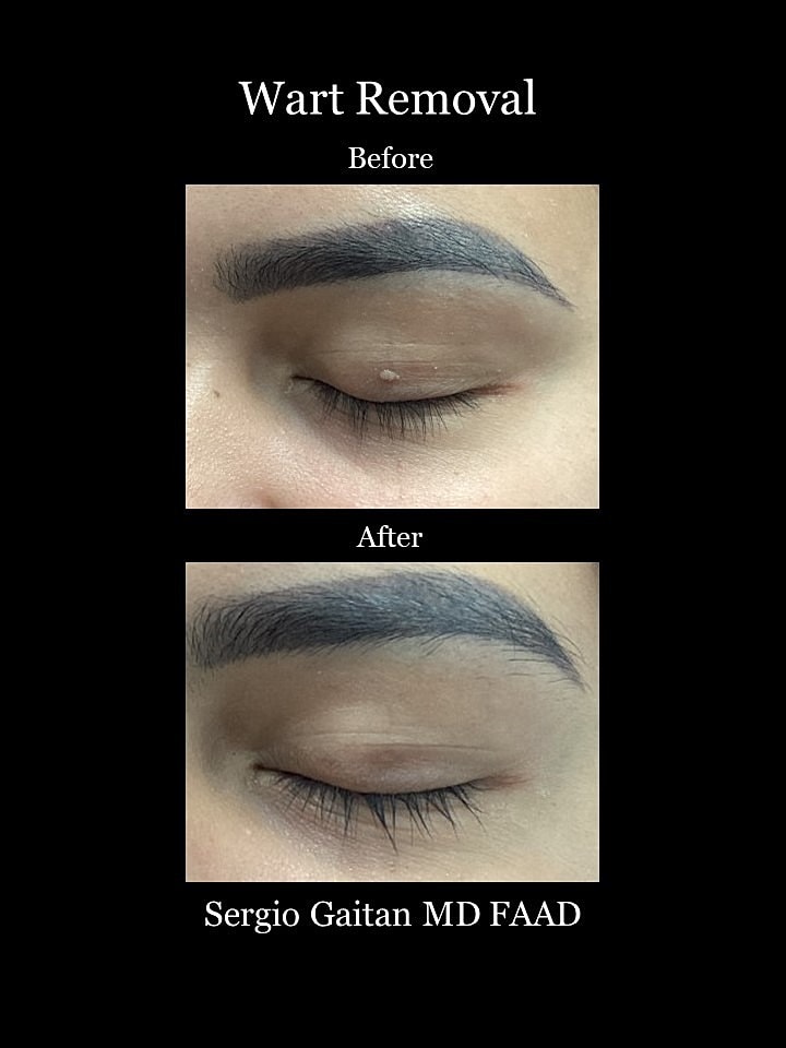Wart Removal Before & After